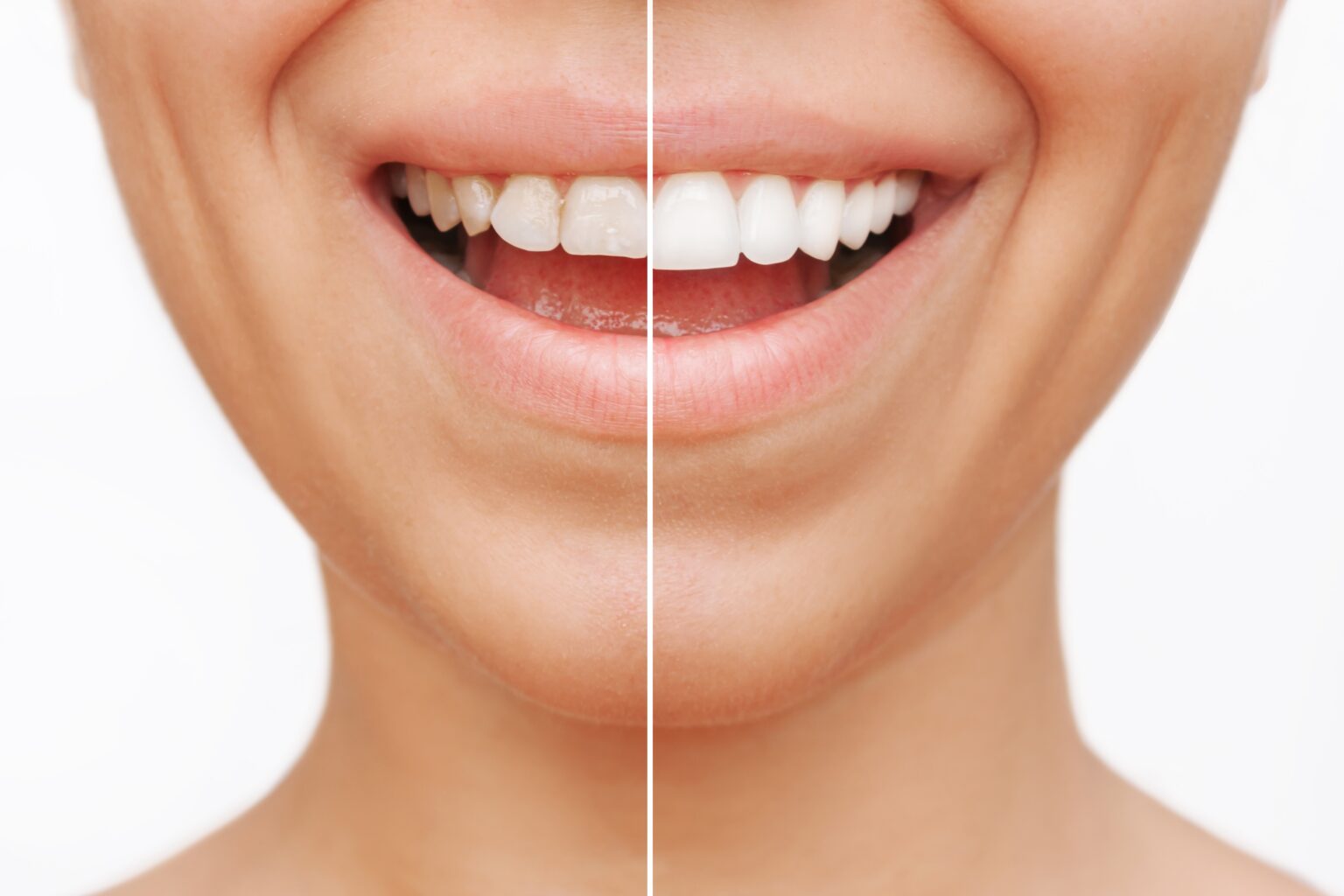 closeup cropped shot of before and after veneers treatment